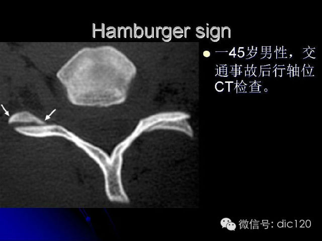 【PPT】一些经典影像征象图文解析