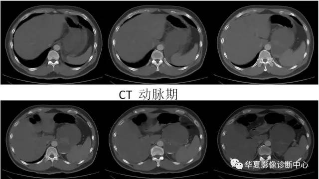 【病例】肾上腺畸胎瘤1例CT影像表现