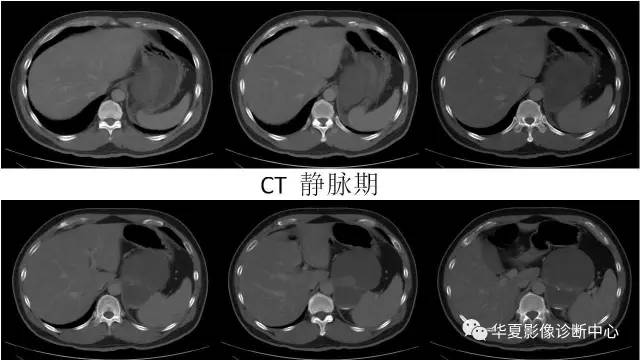 【病例】肾上腺畸胎瘤1例CT影像表现