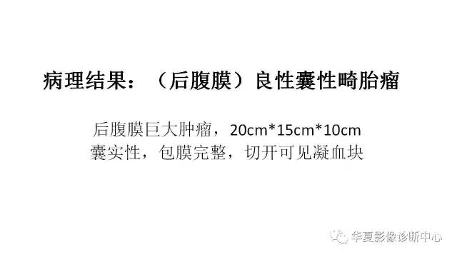 【病例】肾上腺畸胎瘤1例CT影像表现