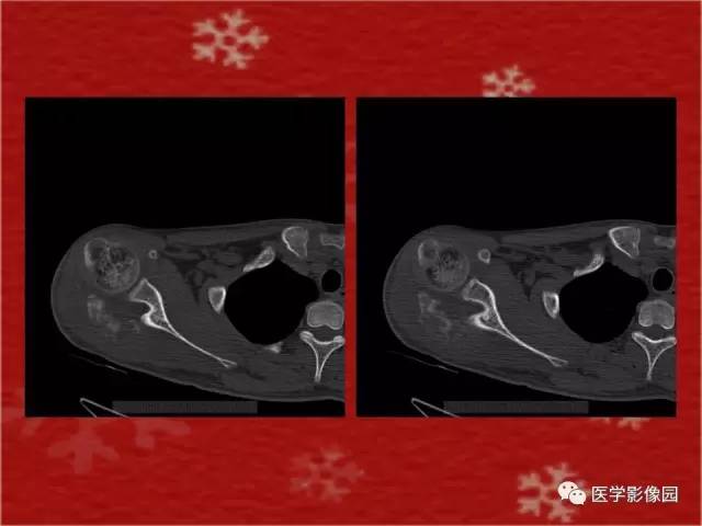 【病例】肩胛骨尤文氏肉瘤1例X线CT