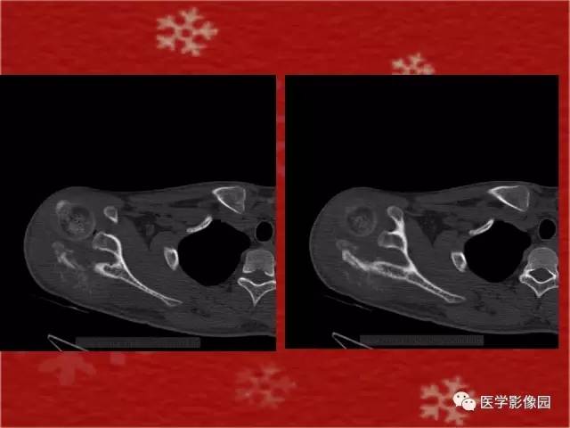 【病例】肩胛骨尤文氏肉瘤1例X线CT