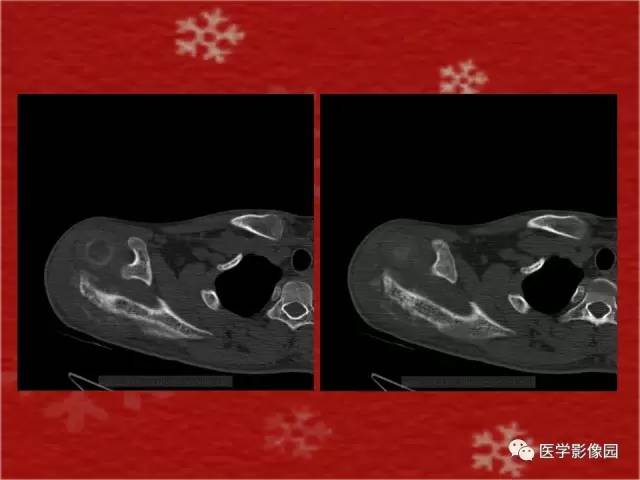 【病例】肩胛骨尤文氏肉瘤1例X线CT