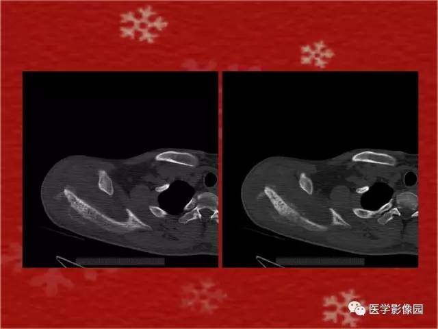 【病例】肩胛骨尤文氏肉瘤1例X线CT