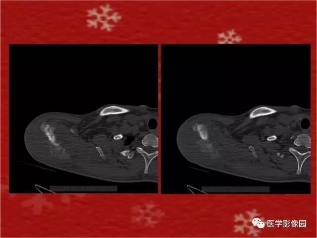 【病例】肩胛骨尤文氏肉瘤1例X线CT