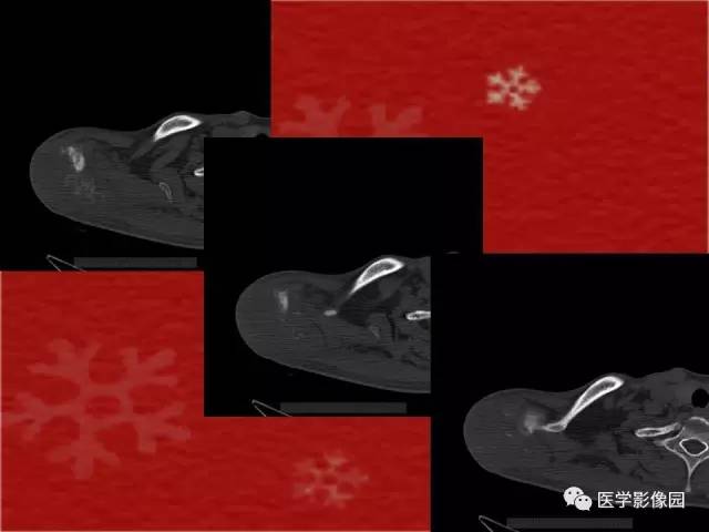 【病例】肩胛骨尤文氏肉瘤1例X线CT