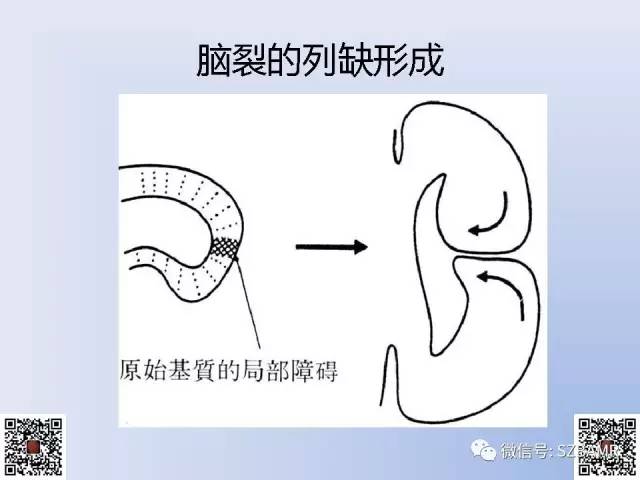 【PPT】脑裂畸形的MRI表现