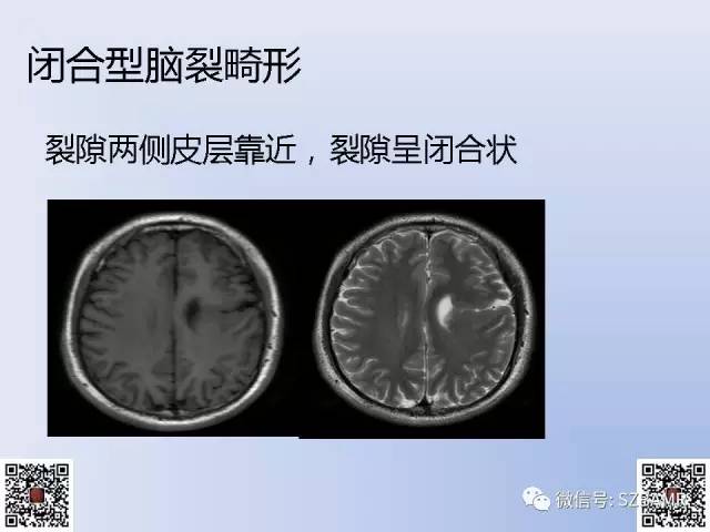 【PPT】脑裂畸形的MRI表现