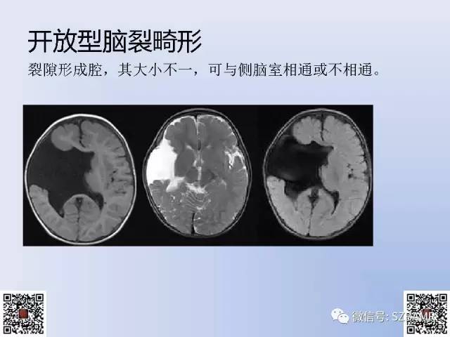 【PPT】脑裂畸形的MRI表现