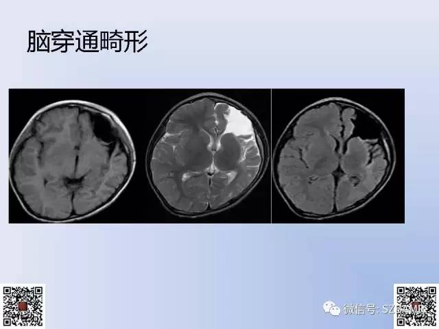 【PPT】脑裂畸形的MRI表现