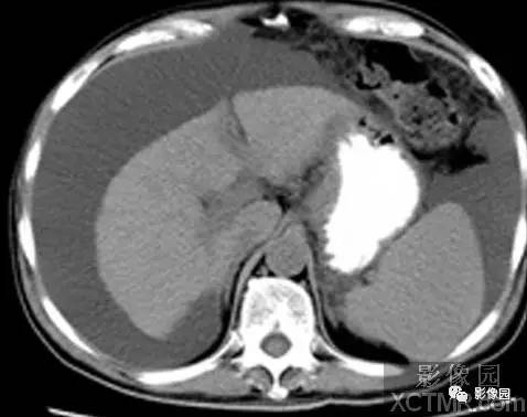 【病例】肝硬化1例CT影像诊断分析 【病例】肝硬化1例CT影像诊断分析