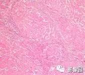 【病例】肝硬化1例CT影像诊断分析 【病例】肝硬化1例CT影像诊断分析