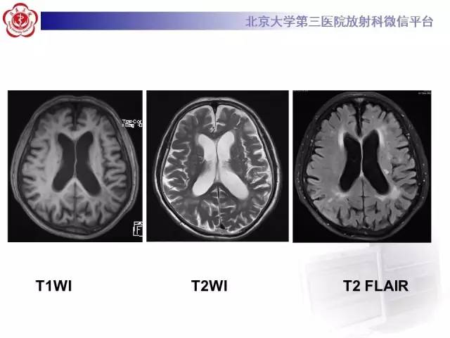 【病例】脑淀粉样血管病1例MR