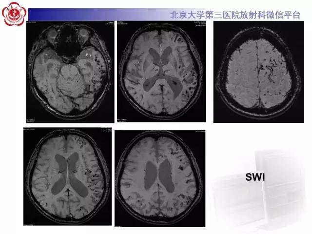 【病例】脑淀粉样血管病1例MR