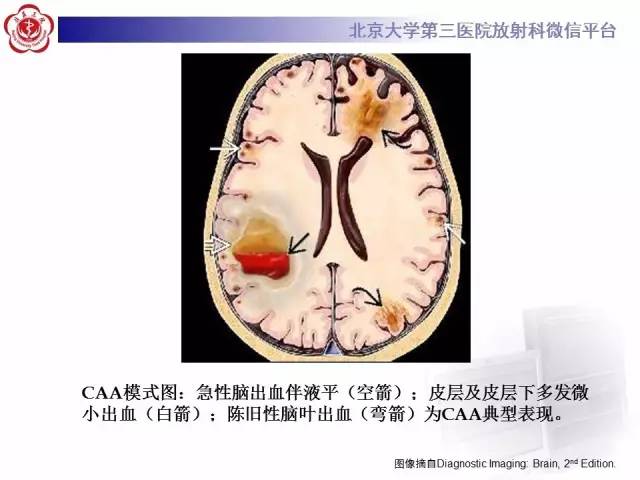 【病例】脑淀粉样血管病1例MR