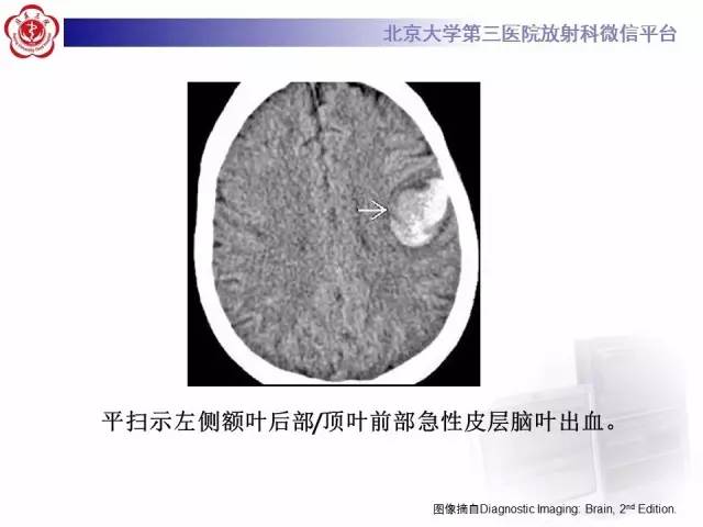 【病例】脑淀粉样血管病1例MR