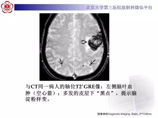 【病例】脑淀粉样血管病1例MR