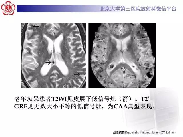 【病例】脑淀粉样血管病1例MR
