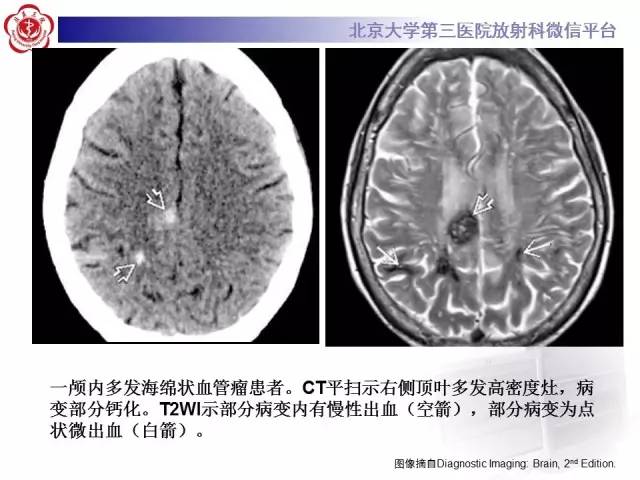 【病例】脑淀粉样血管病1例MR