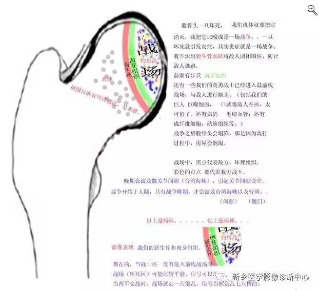 一幅图掌握股骨头坏死病理病因和发展过程