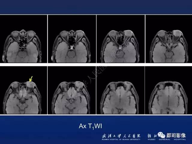 【PPT】眼眶淋巴增生性病变影像诊断