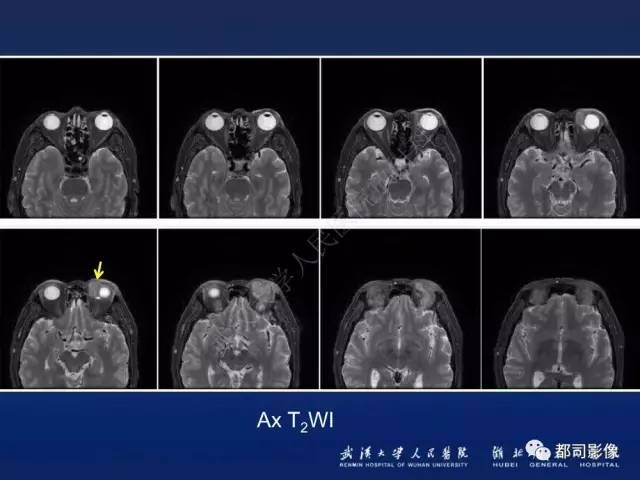 【PPT】眼眶淋巴增生性病变影像诊断
