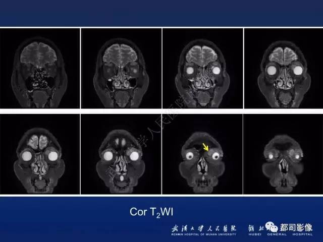 【PPT】眼眶淋巴增生性病变影像诊断