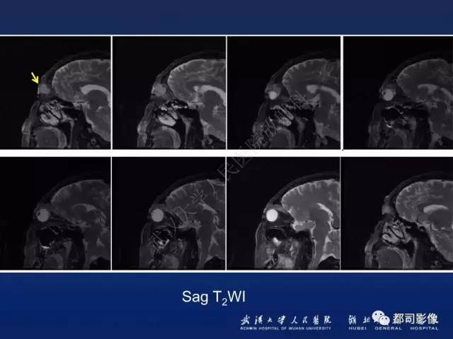 【PPT】眼眶淋巴增生性病变影像诊断