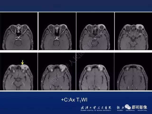 【PPT】眼眶淋巴增生性病变影像诊断