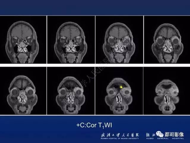 【PPT】眼眶淋巴增生性病变影像诊断