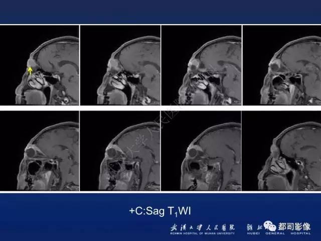 【PPT】眼眶淋巴增生性病变影像诊断