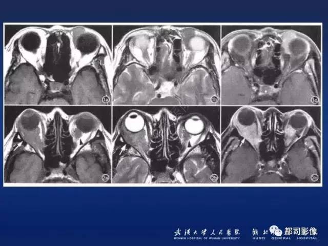 【PPT】眼眶淋巴增生性病变影像诊断