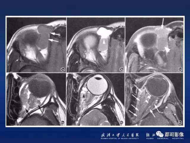 【PPT】眼眶淋巴增生性病变影像诊断