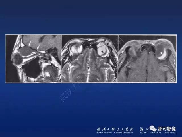 【PPT】眼眶淋巴增生性病变影像诊断