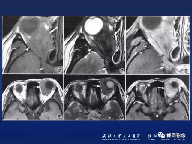 【PPT】眼眶淋巴增生性病变影像诊断