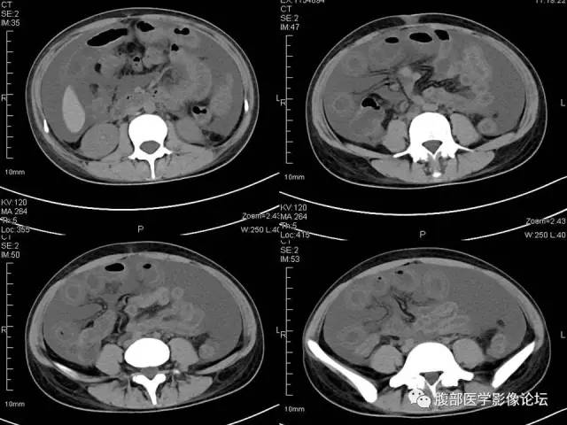 【病例】狼疮性肠系膜血管炎1例CT 【病例】狼疮性肠系膜血管炎1例CT