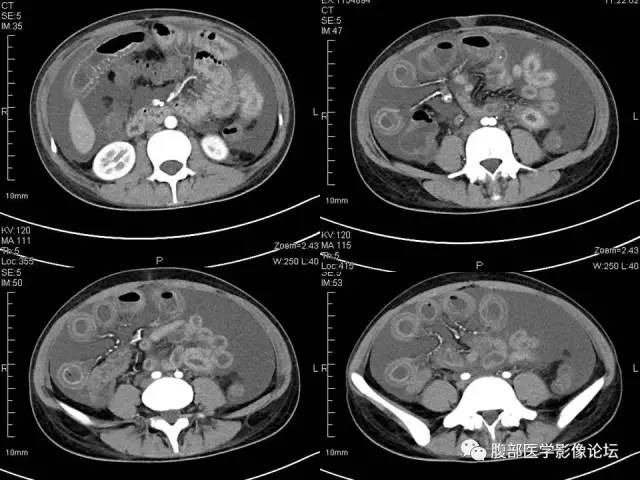 【病例】狼疮性肠系膜血管炎1例CT 【病例】狼疮性肠系膜血管炎1例CT