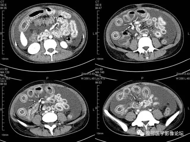 【病例】狼疮性肠系膜血管炎1例CT 【病例】狼疮性肠系膜血管炎1例CT