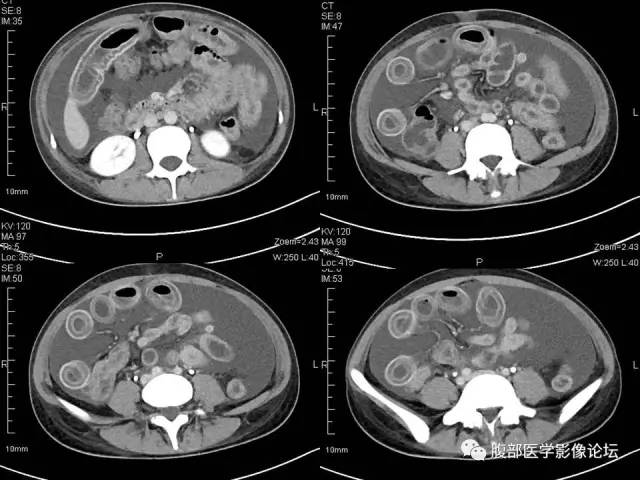 【病例】狼疮性肠系膜血管炎1例CT 【病例】狼疮性肠系膜血管炎1例CT