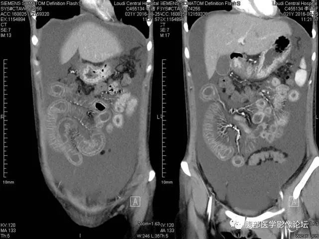 【病例】狼疮性肠系膜血管炎1例CT 【病例】狼疮性肠系膜血管炎1例CT