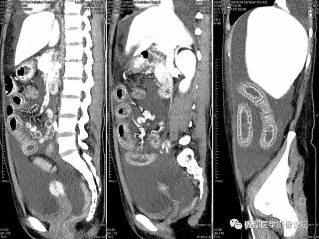 【病例】狼疮性肠系膜血管炎1例CT 【病例】狼疮性肠系膜血管炎1例CT