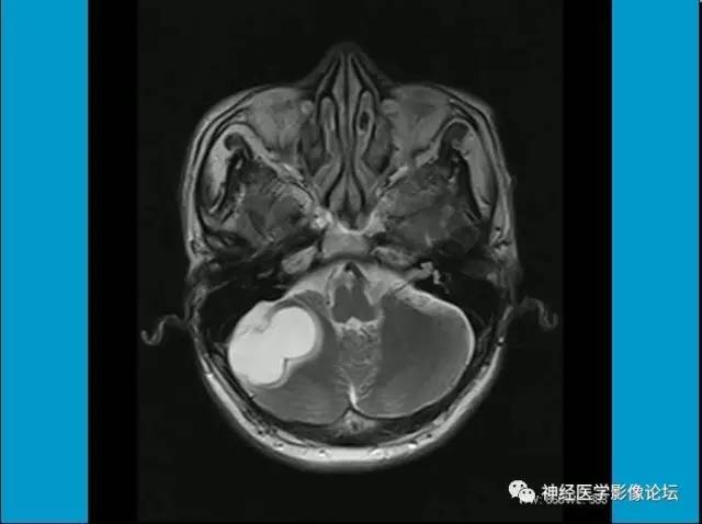 【病例】小脑半球囊性畸胎瘤1例MR