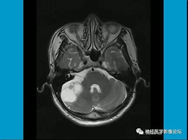 【病例】小脑半球囊性畸胎瘤1例MR