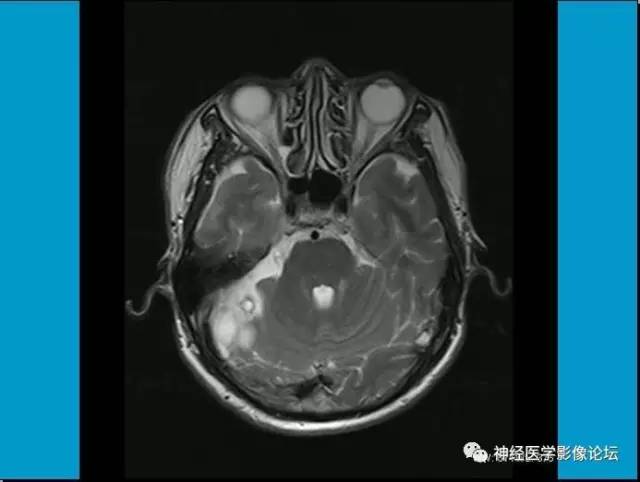 【病例】小脑半球囊性畸胎瘤1例MR