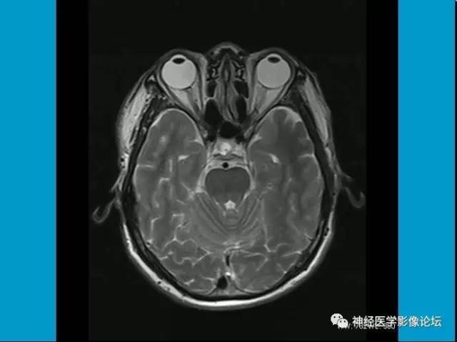 【病例】小脑半球囊性畸胎瘤1例MR