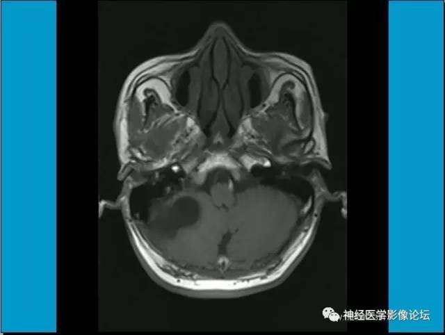 【病例】小脑半球囊性畸胎瘤1例MR