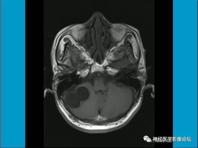 【病例】小脑半球囊性畸胎瘤1例MR
