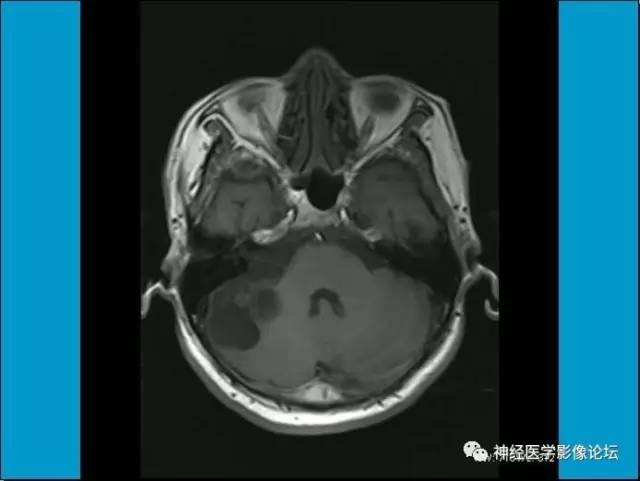 【病例】小脑半球囊性畸胎瘤1例MR