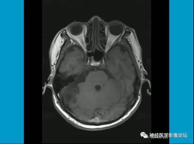 【病例】小脑半球囊性畸胎瘤1例MR