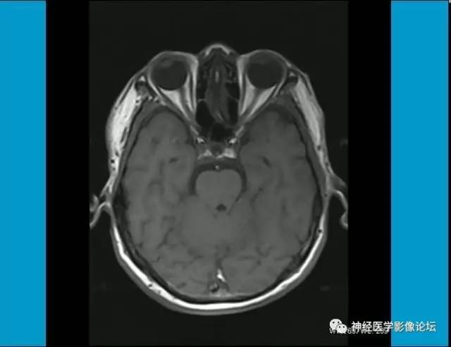 【病例】小脑半球囊性畸胎瘤1例MR
